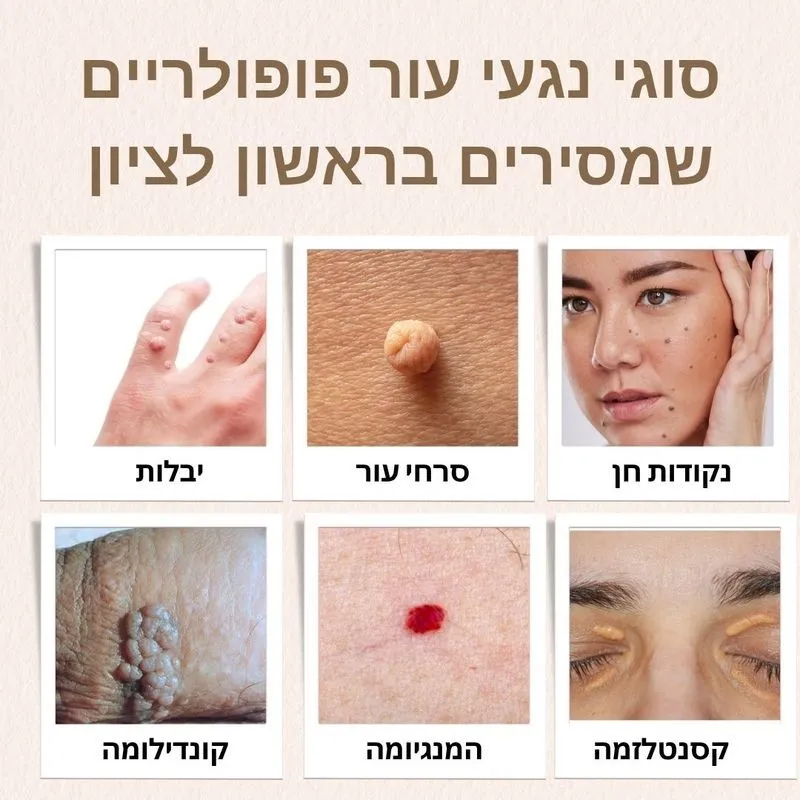 הסרת נגעי עור בראשון לציון