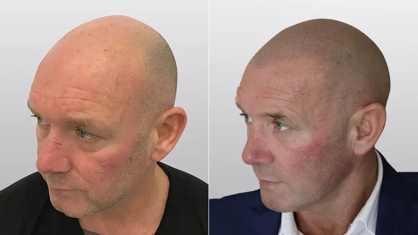 הדמיית שיער לפני ואחרי