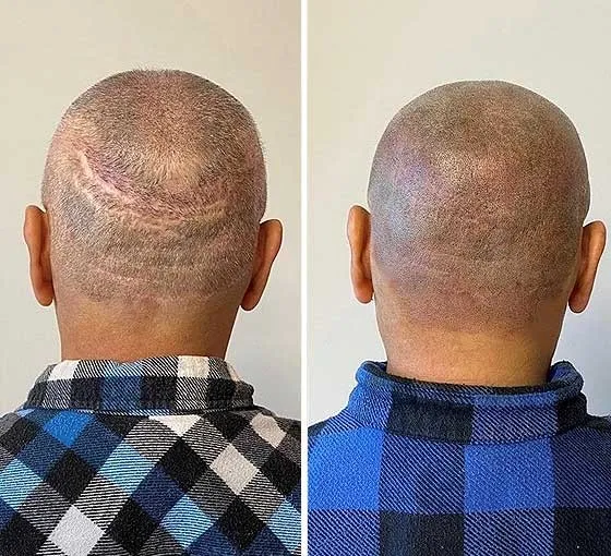 העלמת צלקות בהדמיית שיער לפני ואחרי