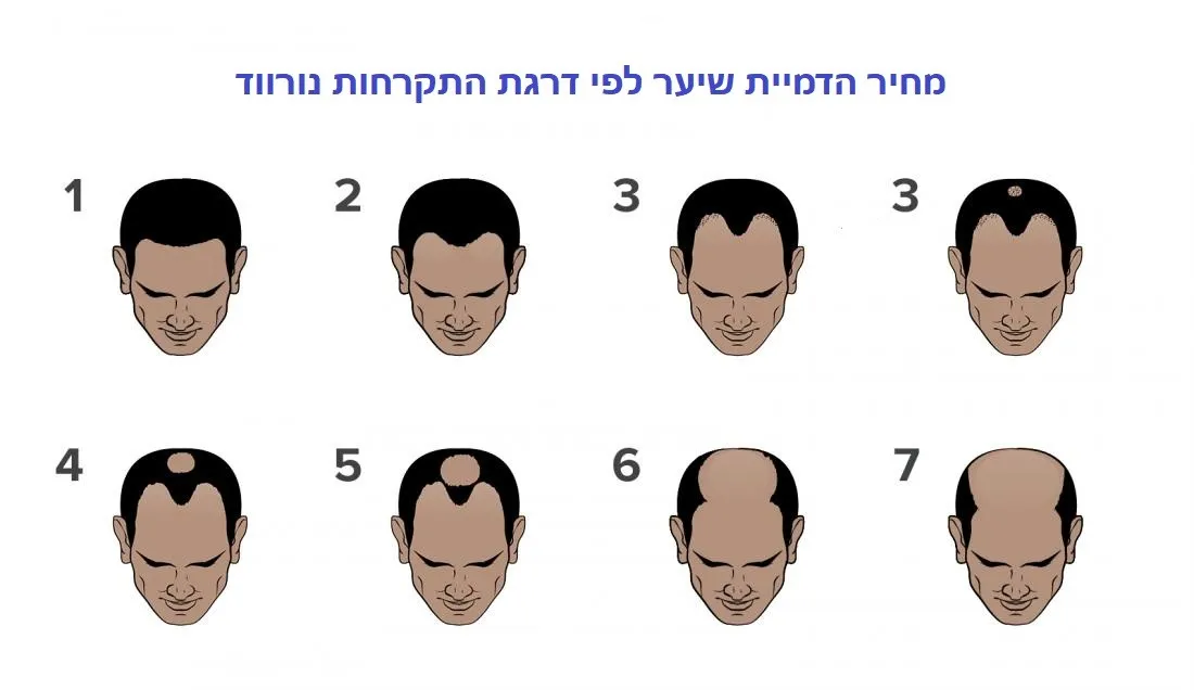 הדמיית שיער מחיר לפי דרגת התקרחות נרווד