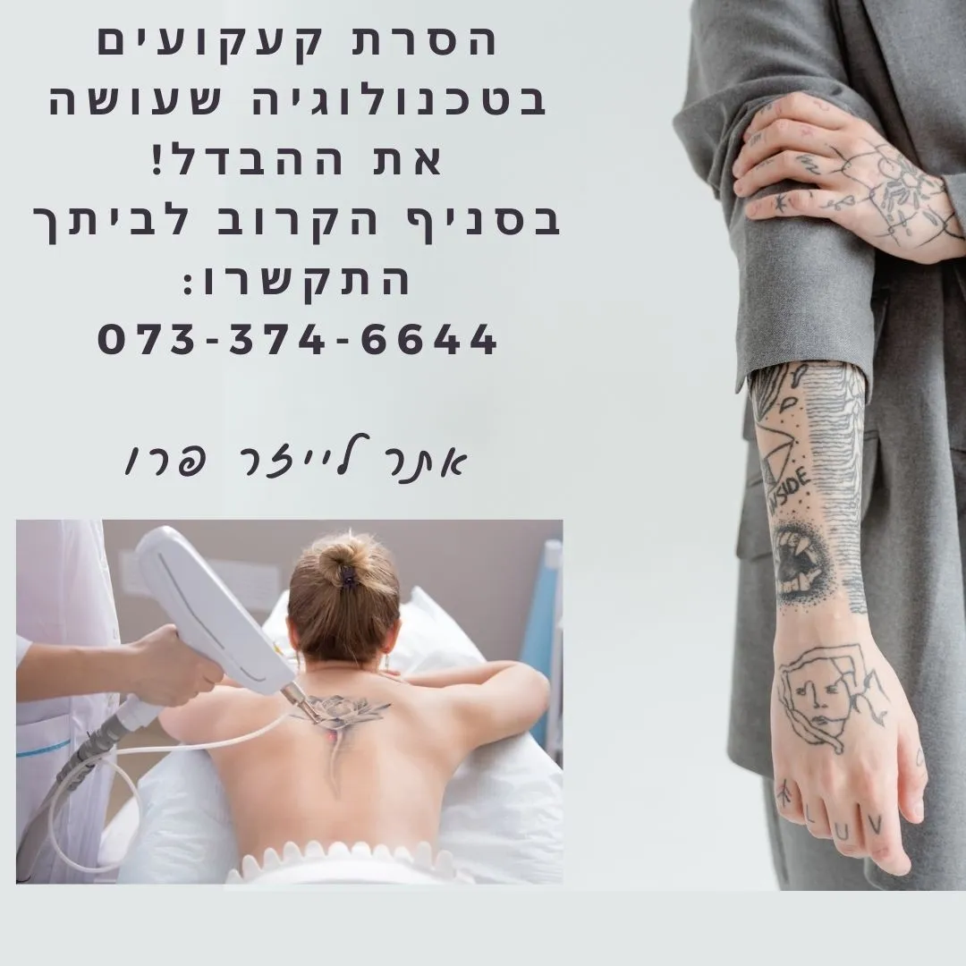 הסרת קעקועים בקריית מוצקין