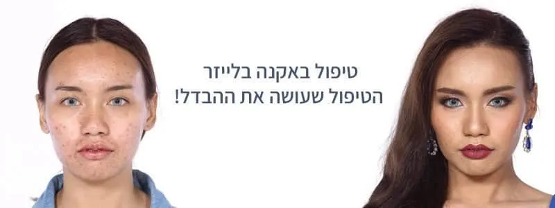 טיפול באקנה בקריית מוצקין בלייזר