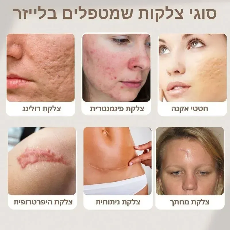 הסרת צלקות בקריית מוצקין