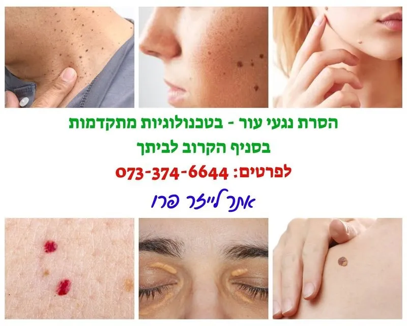 הסרת נגעי עור בקריית מוצקין