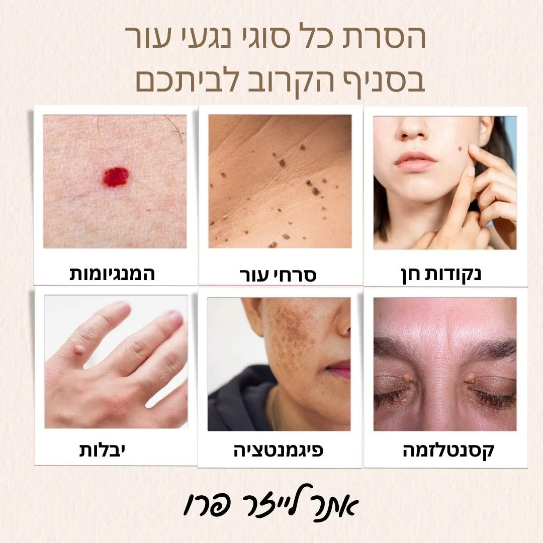 הסרת נגעי עור בקריית מוצקין