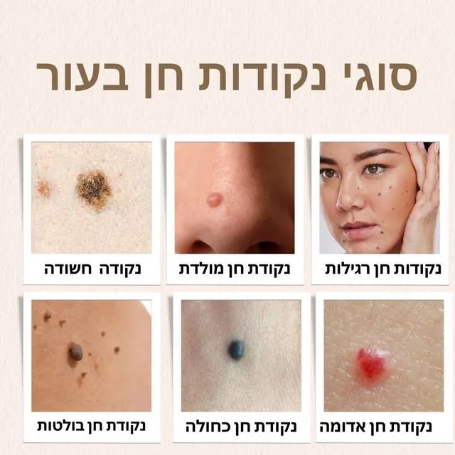 סוגי נקודות חן בעור