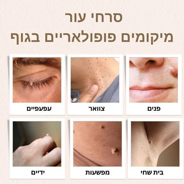 סרחי עור - מיקומים פופולאריים בגוף