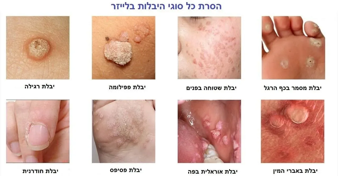 הסרת כל סוגי היבלות