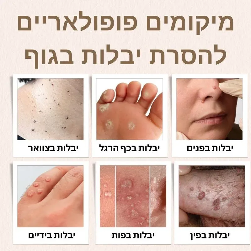 מיקומים פופולאריים להסרת יבלות בגוף