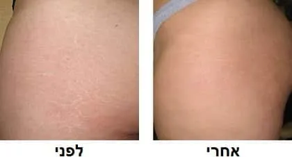 העלמת סימני מתיחה בירכיים - לפני ואחרי