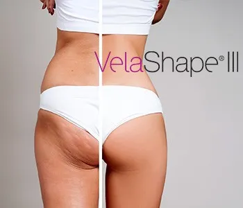 טיפול בצלוליט ב VELASHAPE III