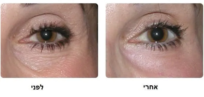 מילוי שקעים מתחת לעיניים לפני ואחרי