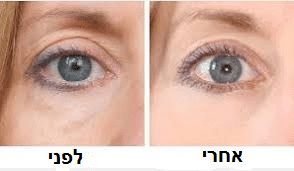 מילוי שקעים מתחת לעיניים לפני ואחרי