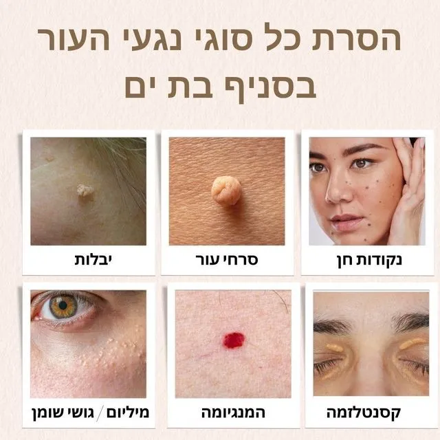 הסרת נגעי עור בבת ים